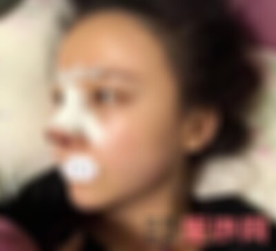 成美整形鼻翼缩小怎么样