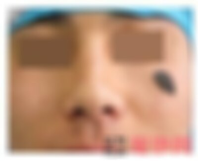 北京丽都医疗美容医院点痣多少钱