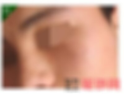 北京丽都医疗美容医院点痣多少钱