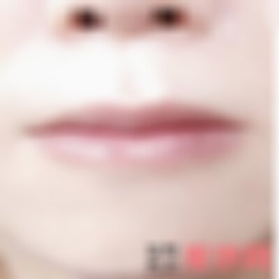 成都军建医院厚唇改薄可以么