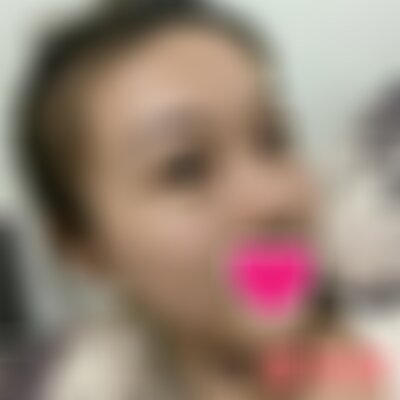 保定华美医疗瘦脸*打的怎么样
