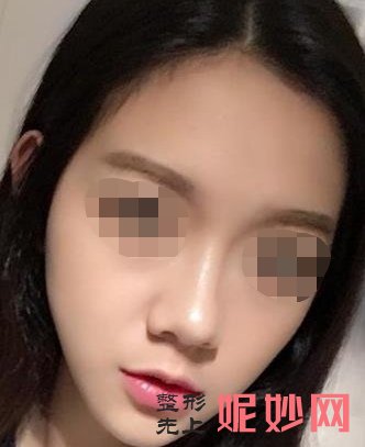 深圳北大医院鼻子整形多少钱