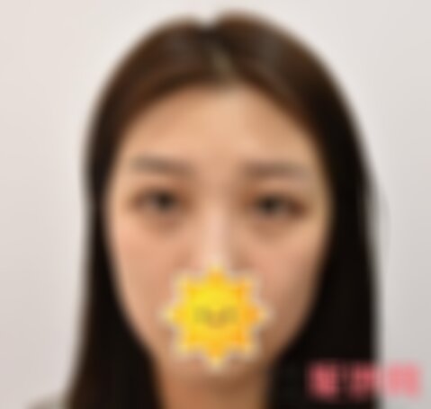 四川米兰柏羽做内切眼袋如何