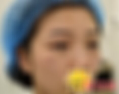 四川米兰柏羽做内切眼袋如何