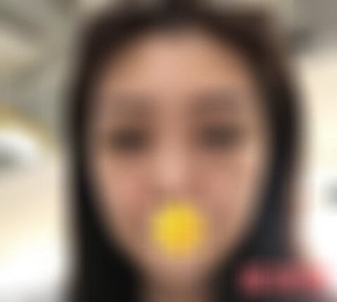 四川米兰柏羽做内切眼袋如何