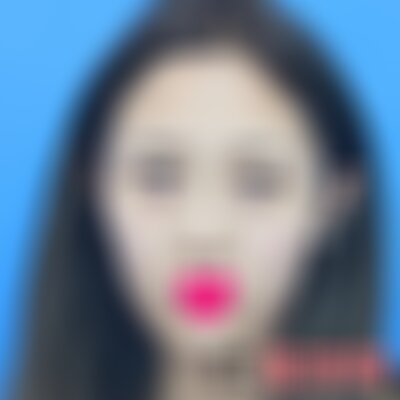 广州曙光双眼皮失败修复案例