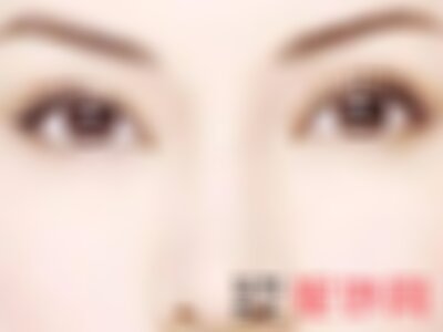 成都玉之光双眼皮做得怎么样