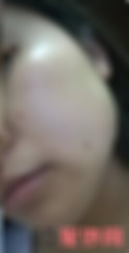 深圳北大医院整形外科切痣怎么样
