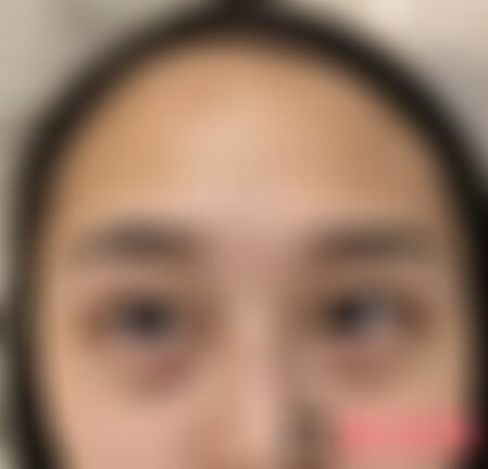 深圳北大医院整形科去眼袋怎么样
