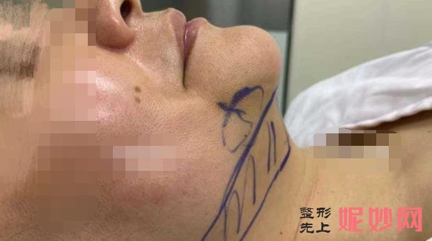 半岛超声炮做一次能维持多久？半岛超声炮作用和费用介绍，附案例！