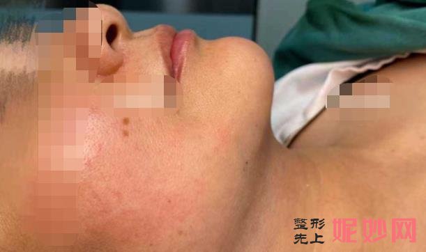 半岛超声炮做一次能维持多久？半岛超声炮作用和费用介绍，附案例！