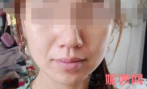 超声炮是超声刀吗？超声炮的作用是什么，价格多少附案例！