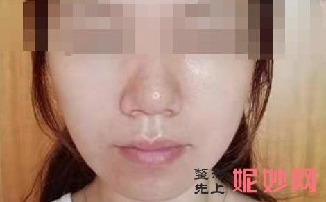 超声炮是超声刀吗？超声炮的作用是什么，价格多少附案例！