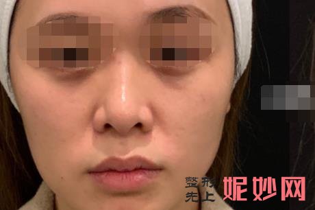 超声炮多少钱一次？超声炮有哪些作用和效果，附案例价格表！