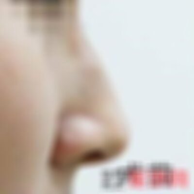 沈阳杏林整形医院驼峰鼻怎么样