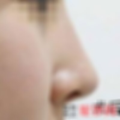 沈阳杏林整形医院驼峰鼻怎么样