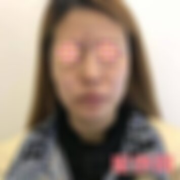 北京薇琳医美祛痘疤痘坑怎么样