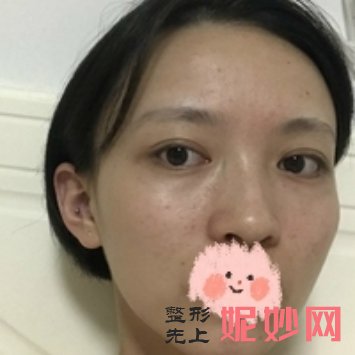 北京润美玉之光脂肪修复怎么样