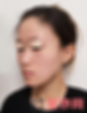 四川悦好双眼皮怎么样