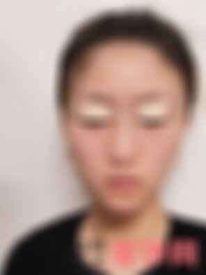 四川悦好双眼皮怎么样