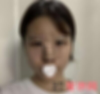 四川米兰柏羽鼻综合案例