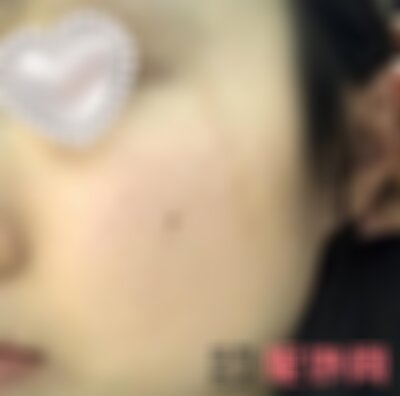 广州曙光可以祛疤痕吗