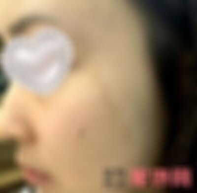 广州曙光可以祛疤痕吗