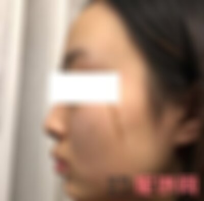 广州曙光可以祛疤痕吗