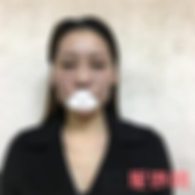 北京华韩自体脂肪填充好吗