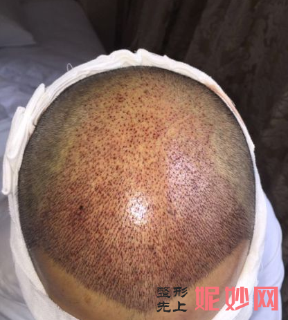 郑州美莱医疗美容医院简介,发际线种植收费表附上案例