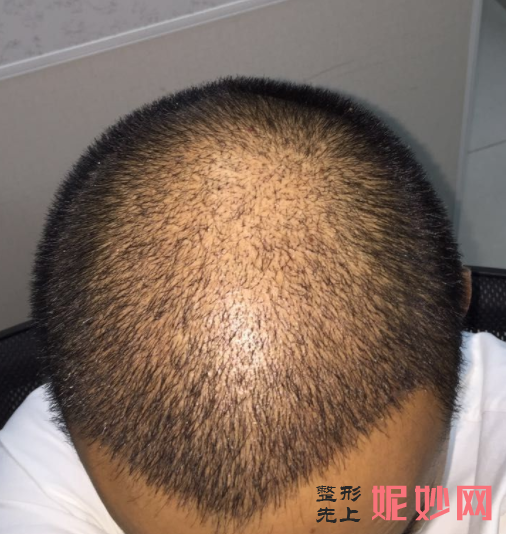 郑州美莱医疗美容医院简介,发际线种植收费表附上案例