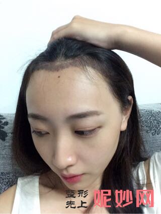 郑州华领医疗美容医院简介,附上发际线种植收费表及案例