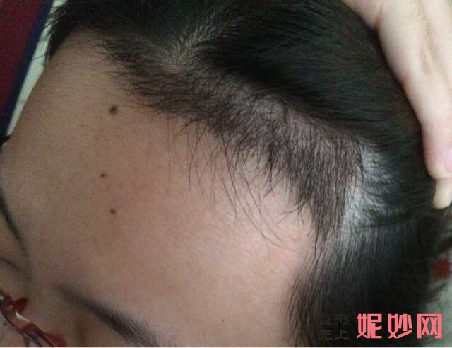 郑州华领医疗美容医院简介,附上发际线种植收费表及案例