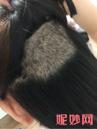 郑州华领医疗美容医院简介,附上发际线种植收费表及案例