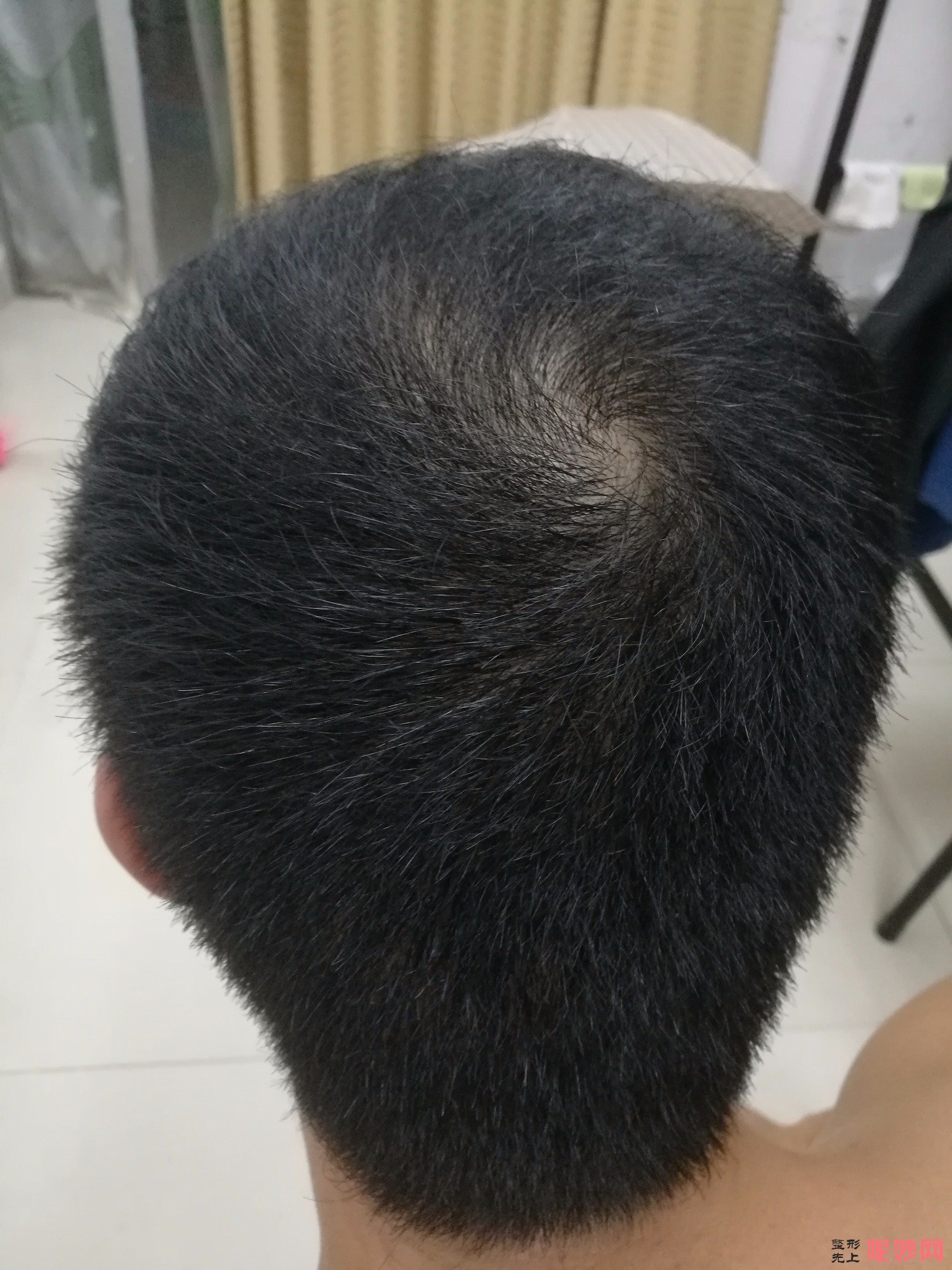 郑州和沐医疗整形口碑怎么样，附发际线种植案例_价格表