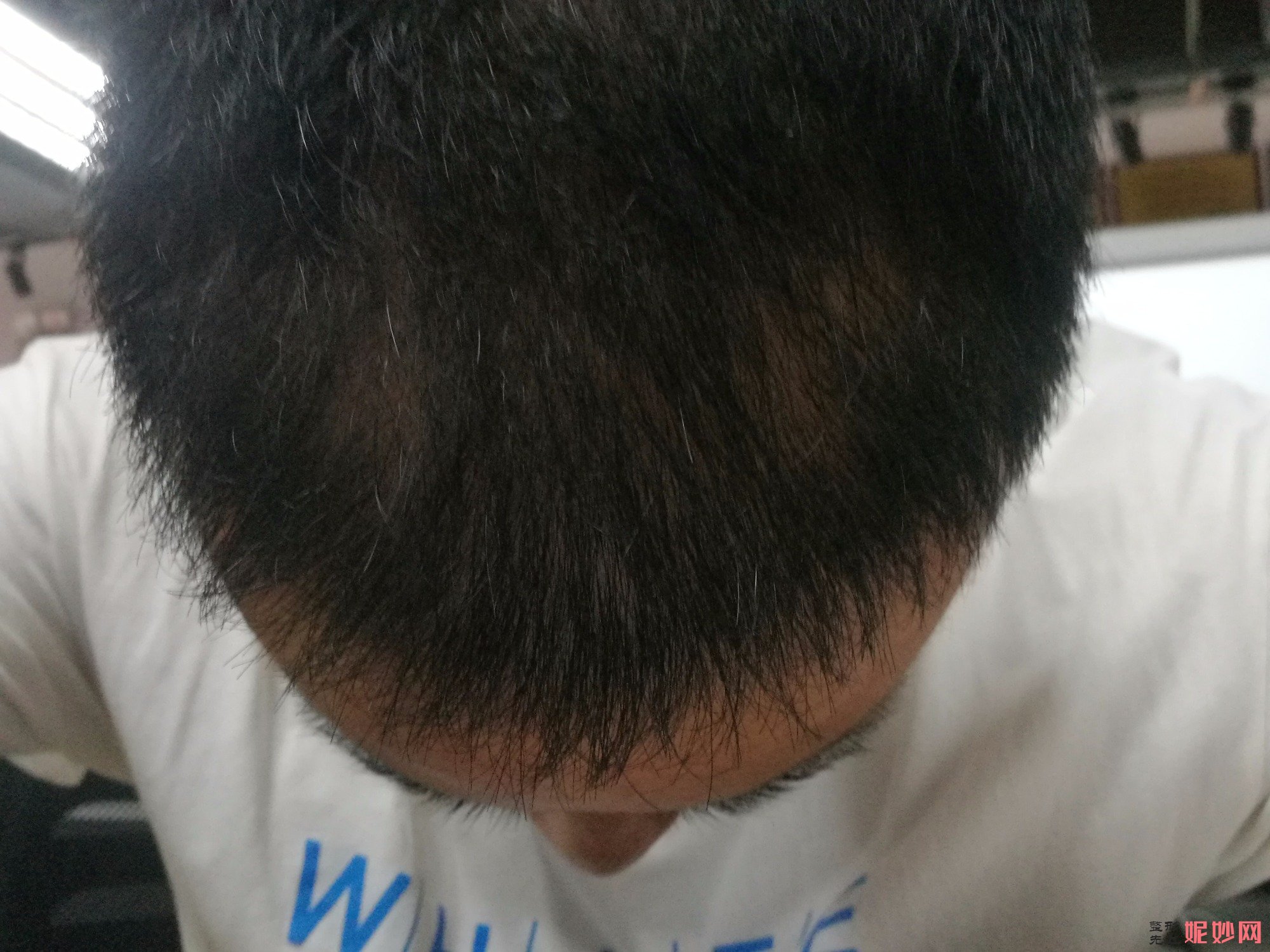 郑州和沐医疗整形口碑怎么样，附发际线种植案例_价格表