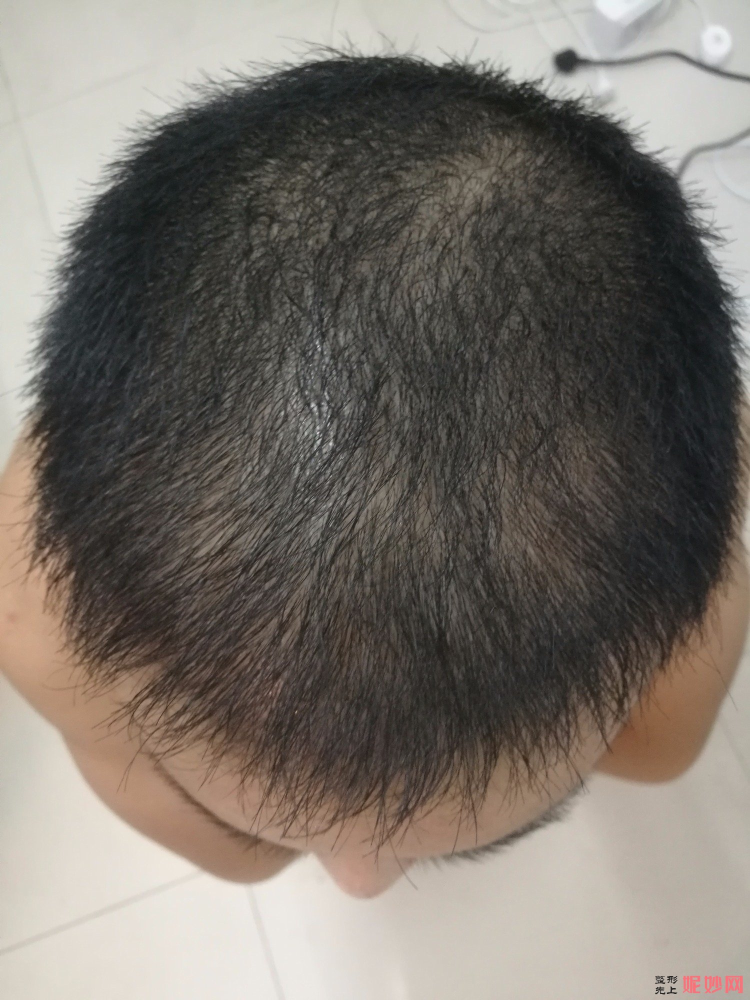 郑州和沐医疗整形口碑怎么样，附发际线种植案例_价格表