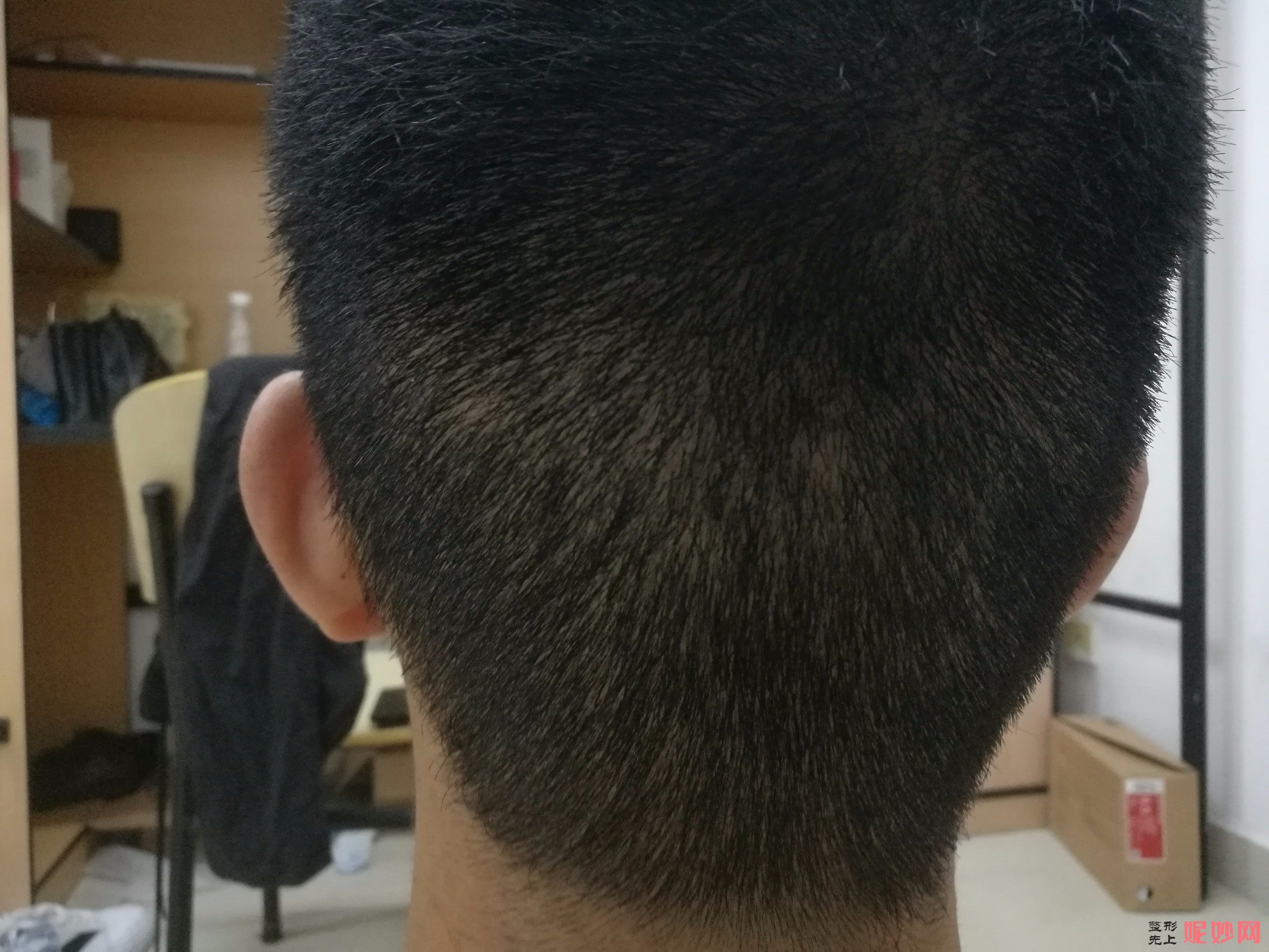 郑州和沐医疗整形口碑怎么样，附发际线种植案例_价格表