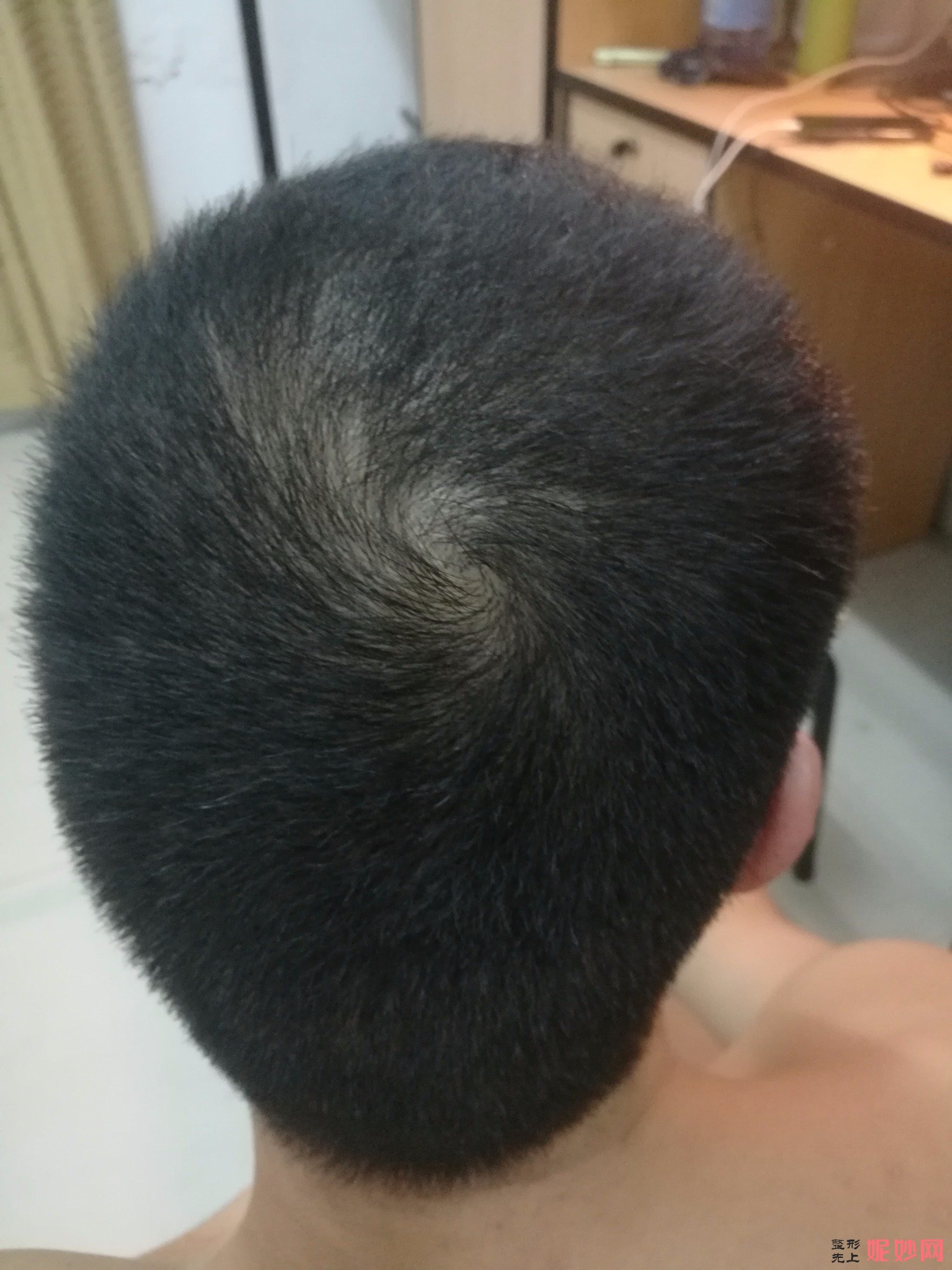 郑州和沐医疗整形口碑怎么样，附发际线种植案例_价格表