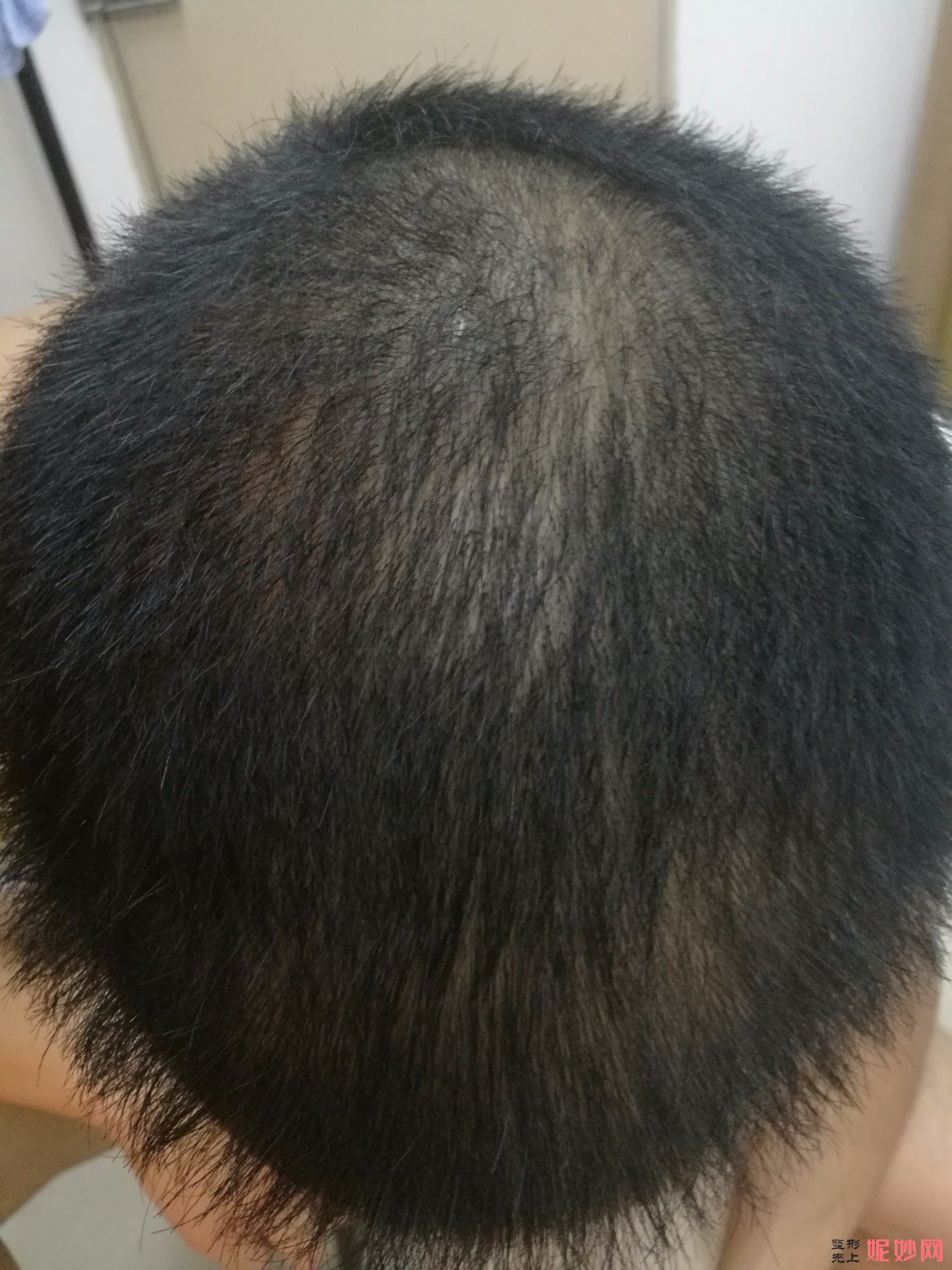 郑州和沐医疗整形口碑怎么样，附发际线种植案例_价格表