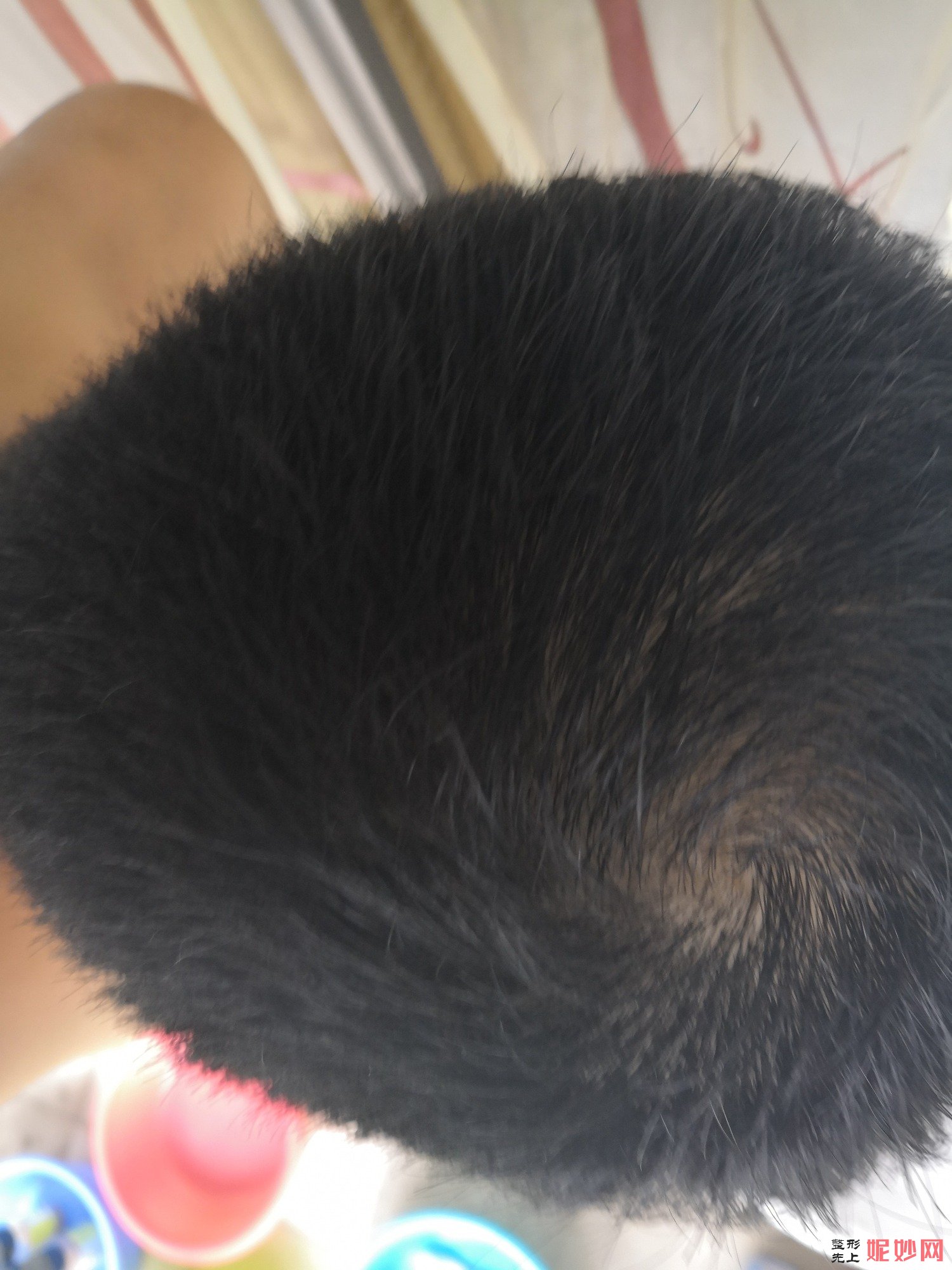 郑州和沐医疗整形口碑怎么样，附发际线种植案例_价格表