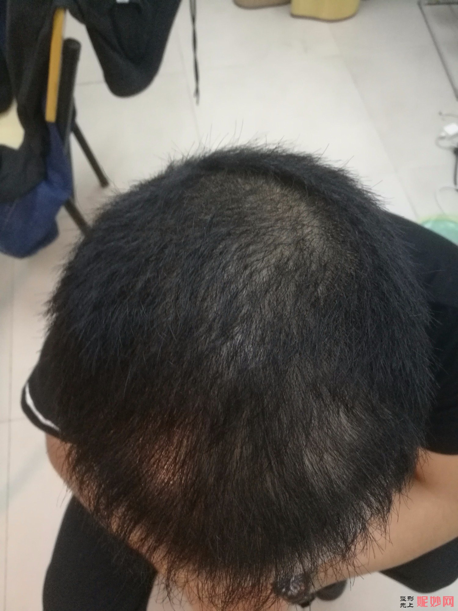 郑州和沐医疗整形口碑怎么样，附发际线种植案例_价格表