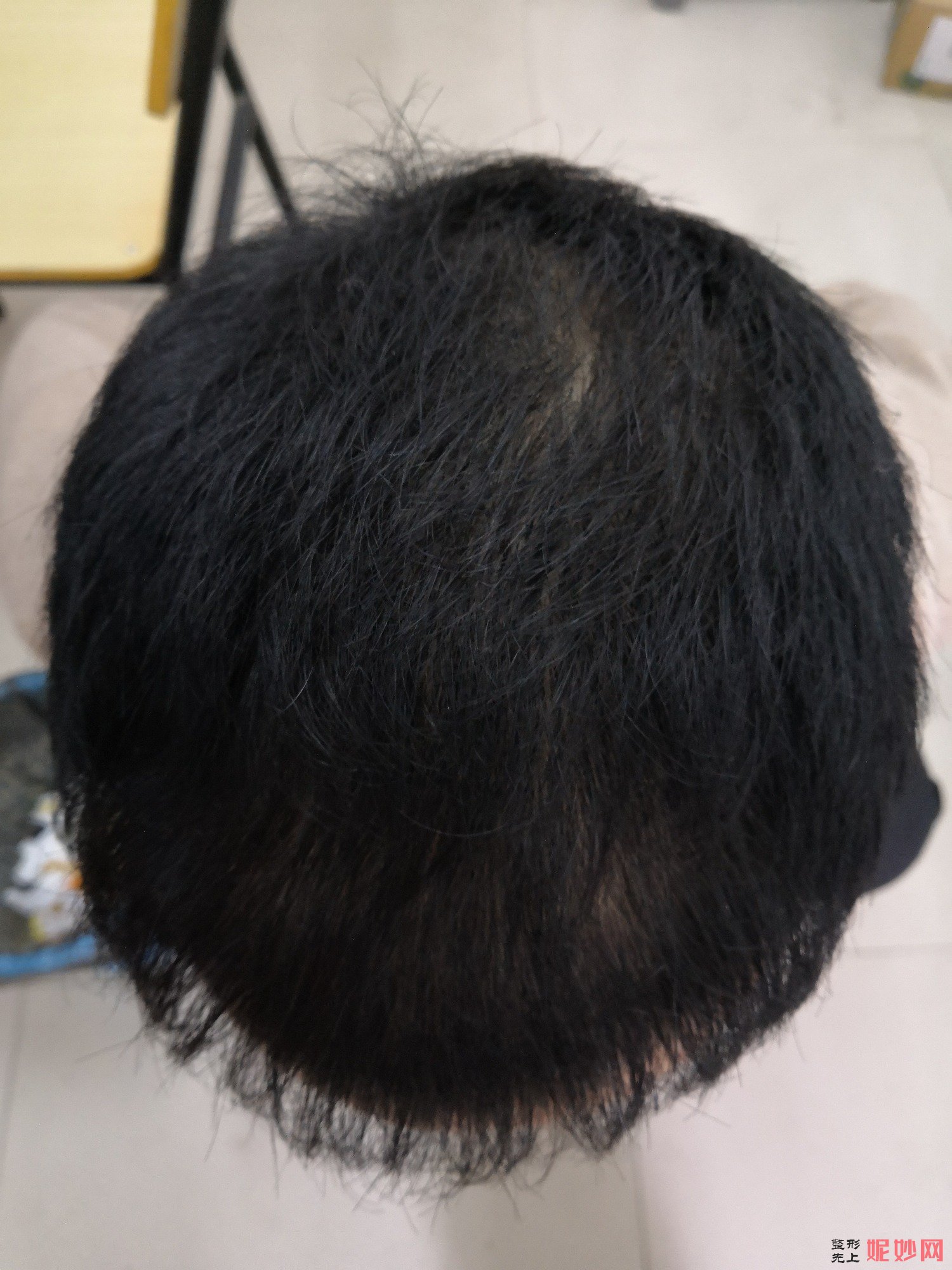 郑州和沐医疗整形口碑怎么样，附发际线种植案例_价格表