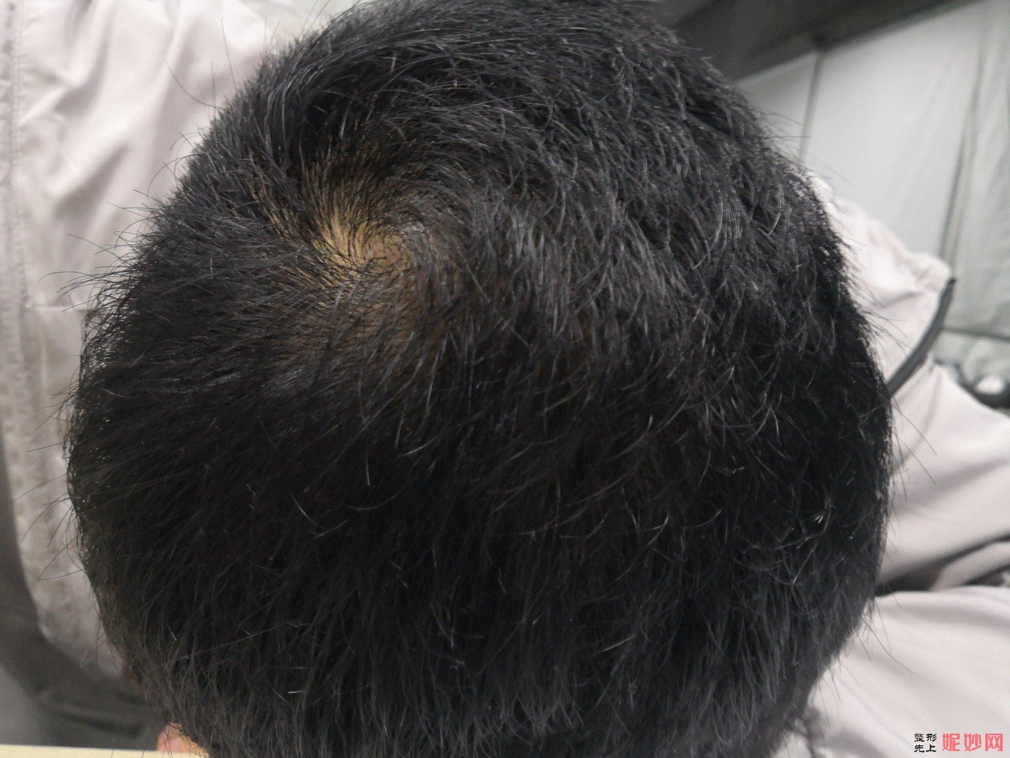 郑州和沐医疗整形口碑怎么样，附发际线种植案例_价格表