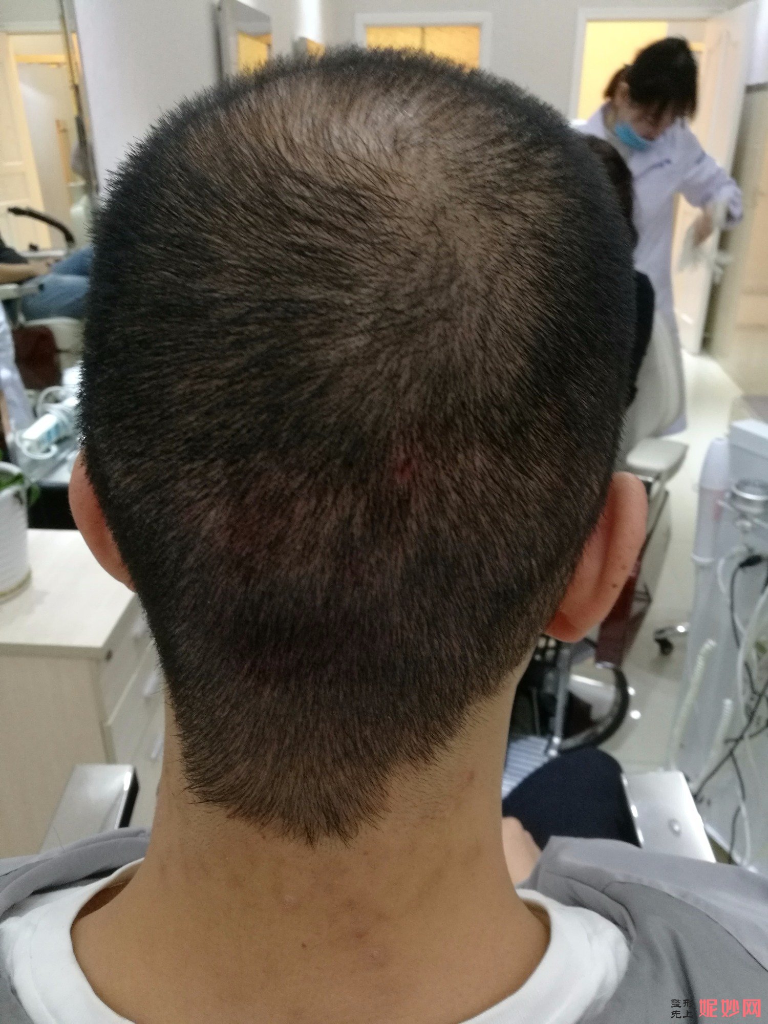 郑州和沐医疗整形口碑怎么样，附发际线种植案例_价格表