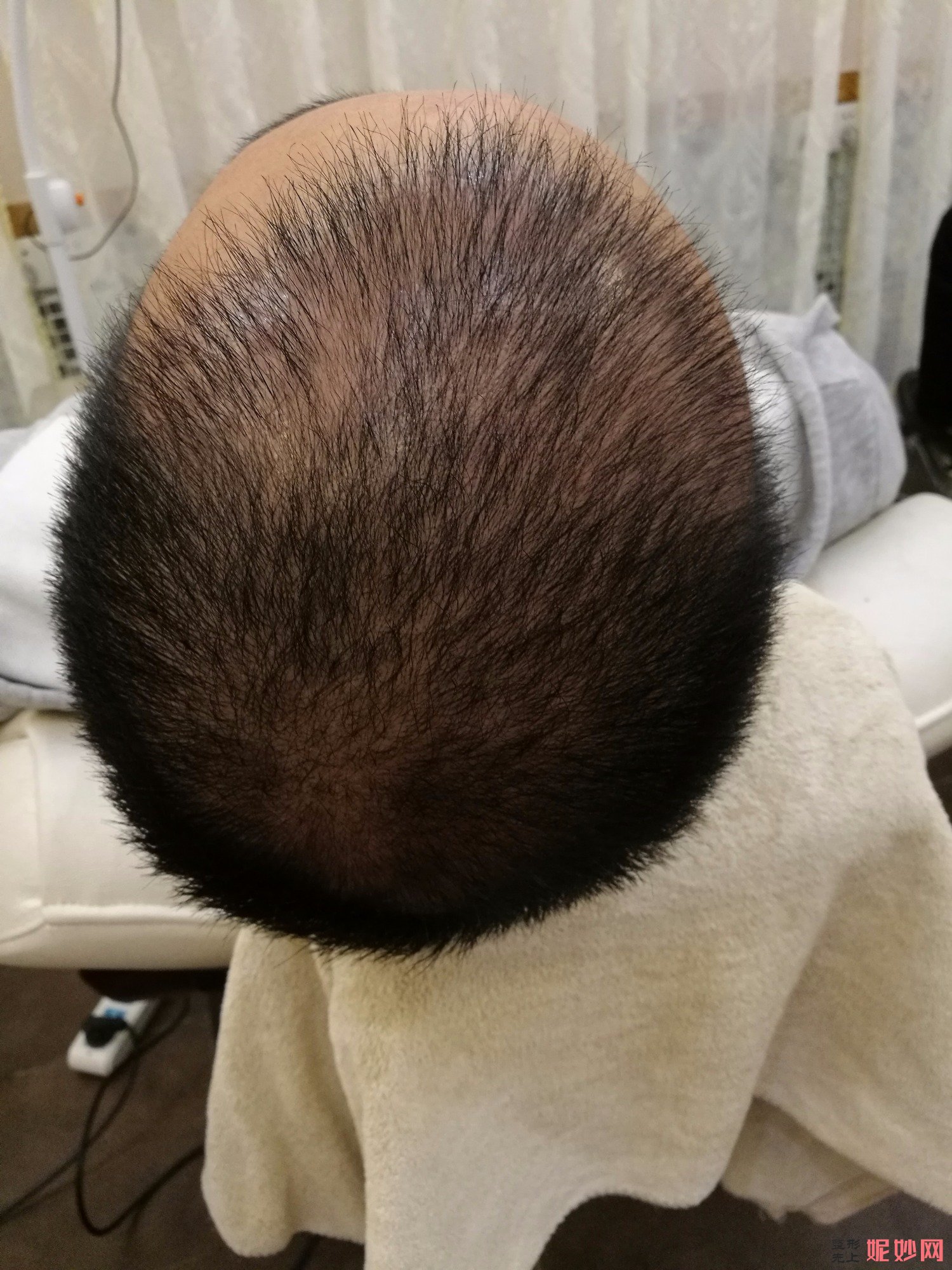 郑州和沐医疗整形口碑怎么样，附发际线种植案例_价格表
