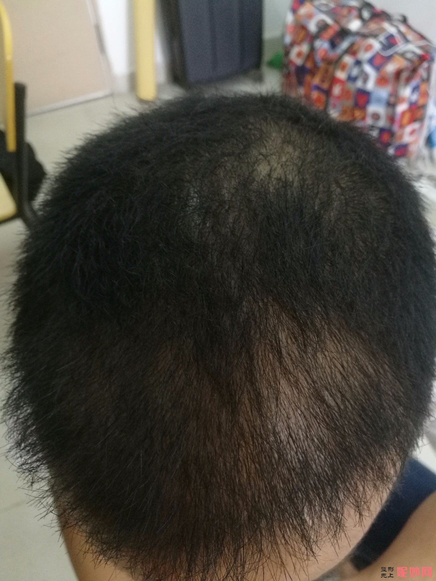 郑州和沐医疗整形口碑怎么样，附发际线种植案例_价格表