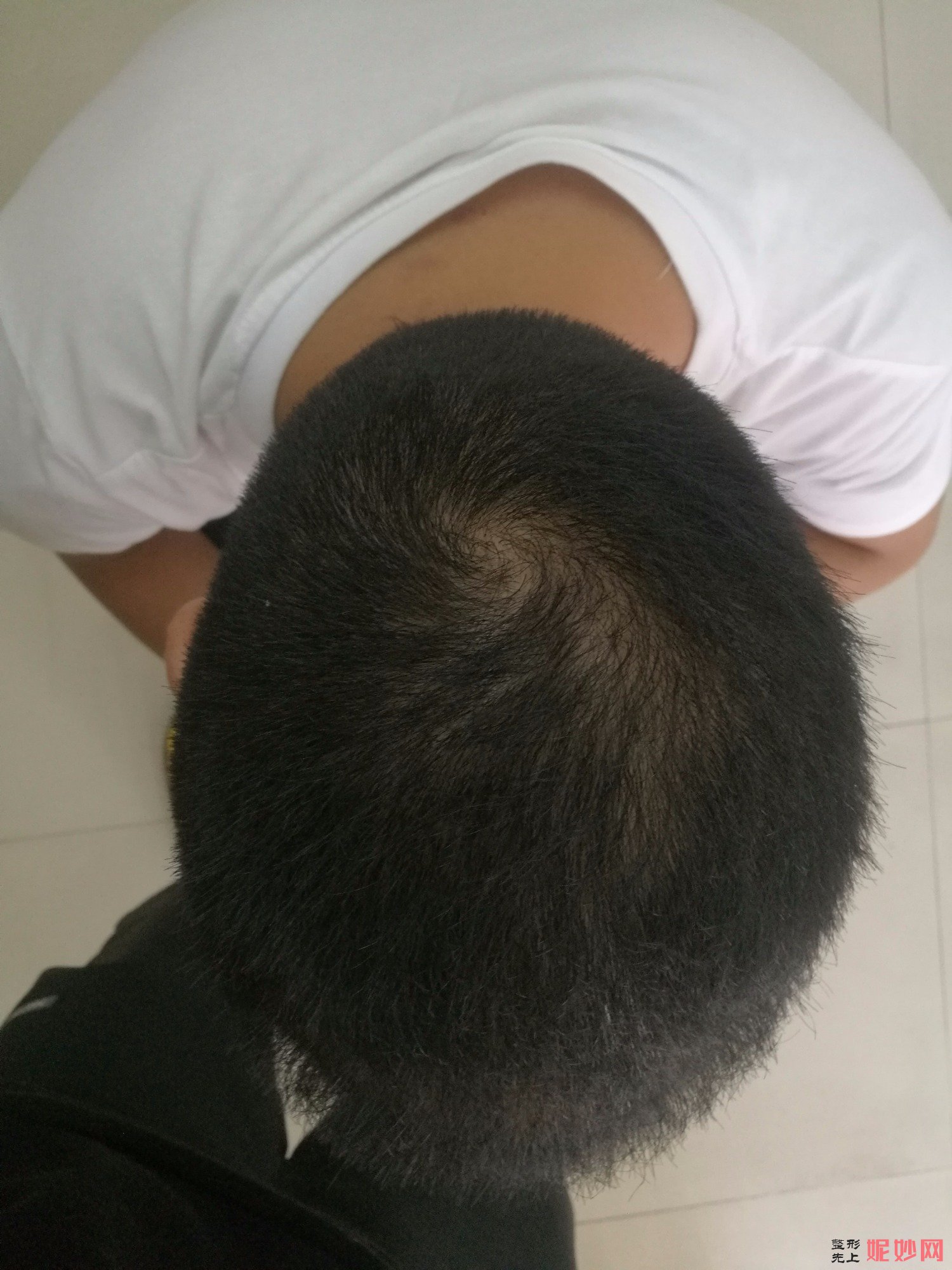 郑州和沐医疗整形口碑怎么样，附发际线种植案例_价格表