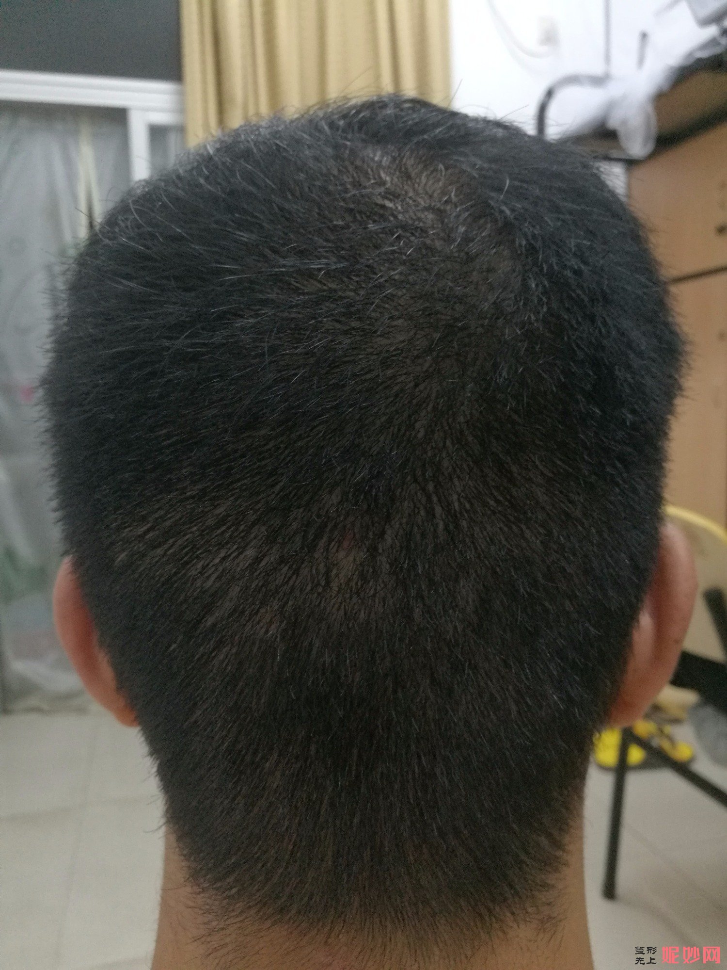 郑州和沐医疗整形口碑怎么样，附发际线种植案例_价格表