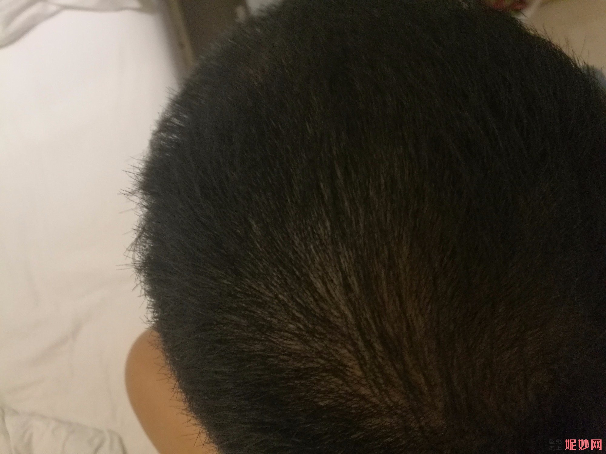 郑州和沐医疗整形口碑怎么样，附发际线种植案例_价格表